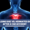 Bulging Disc vs. Herniated Disc After a Car Accident