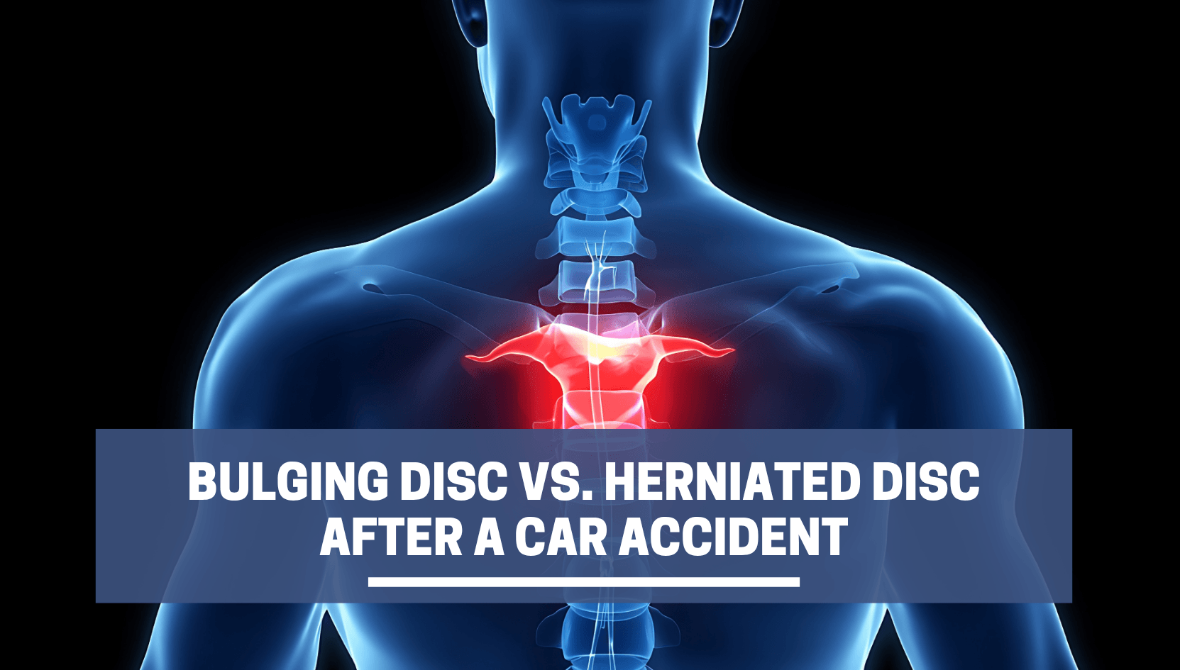 Disco abultado vs.. Hernia de disco después de un accidente automovilístico