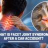 Facet Joint Syndrome After a Car Accident: Symptoms & Claims